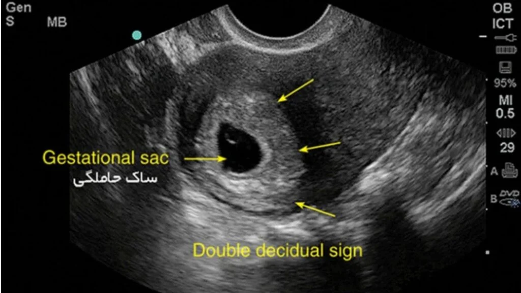 از کجا بفهمم بارداریم پوچ نیست