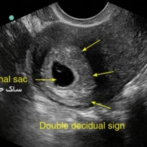 از کجا بفهمم بارداریم پوچ نیست