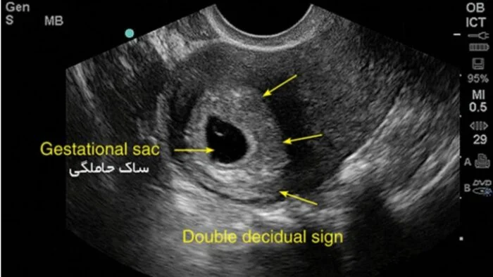از کجا بفهمم بارداریم پوچ نیست